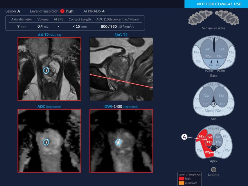 Demo de Paros, IA centrada en cáncer de próstata