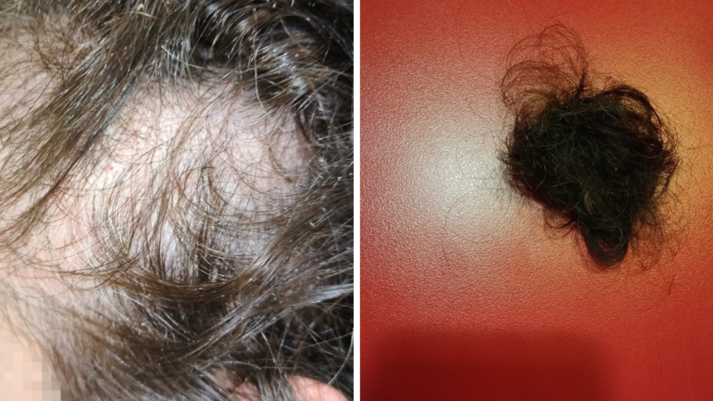 Montaje con los mechones de pelo que la reclusa ha logrado arrancarle a la jefa de turno