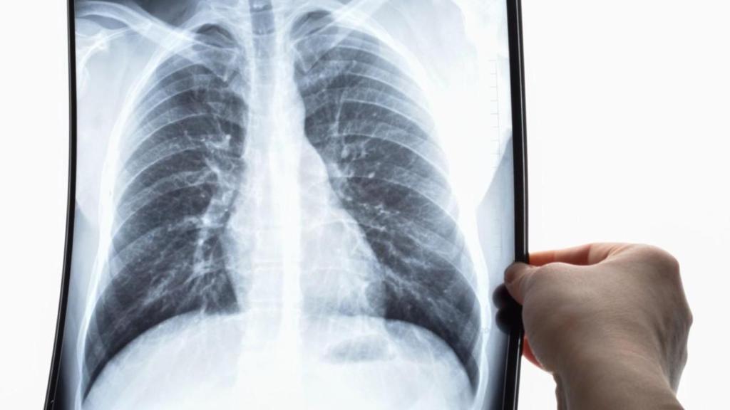 Un especialista observa una radiografia de pulmó