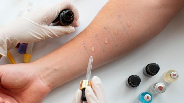 Prueba de alergia en la piel