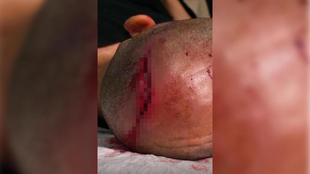 La brecha en la cabeza de una agente de Mossos d'Esquadra, causada por una paliza en Lleida
