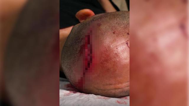 La brecha en la cabeza de una agente de Mossos d'Esquadra, causada por una paliza en Lleida