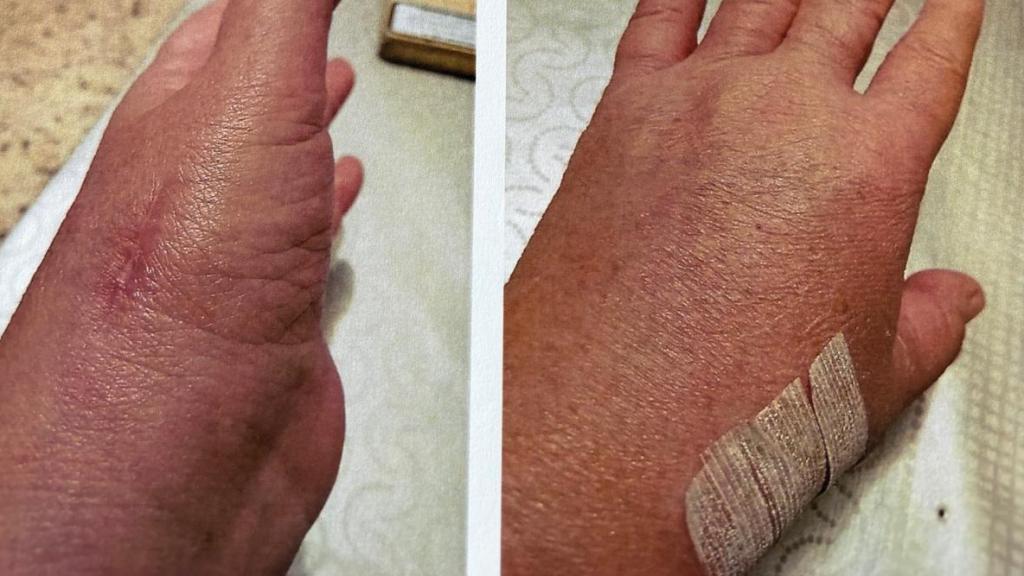 La mano afectada de N.Mallet tras la operación