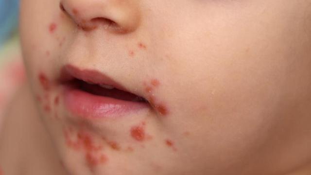 Se trata de una infección que se manifiesta en pequeñas ampollas y costras