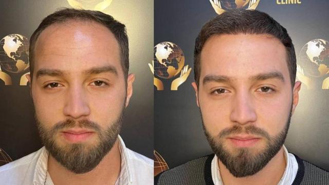 Antes y después de un trasplante capilar