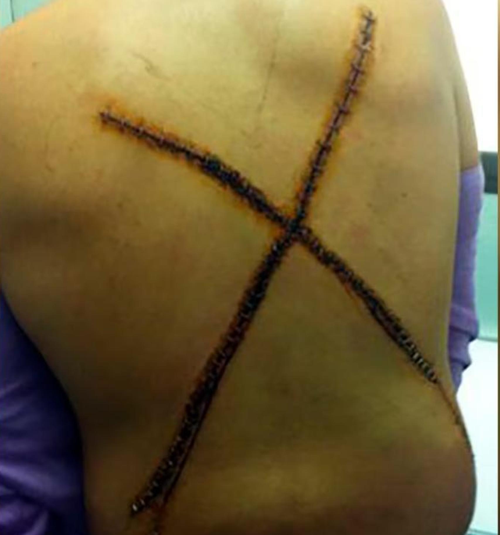 La 'X' realizada por Los Trinitarios en la espalda de un joven que intentó dejar la banda