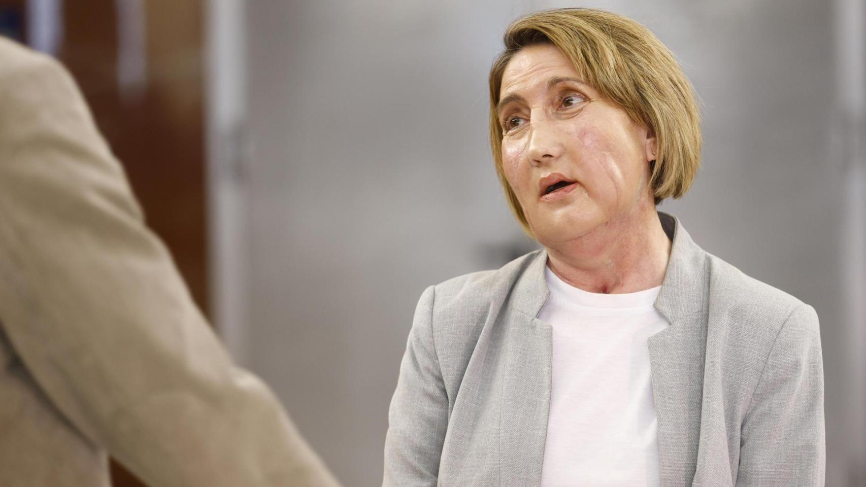 Primer trasplante de cara del mundo de una donante que recibió una eutanasia