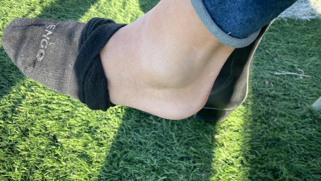 Tobillo de Beatriz tras la lesión