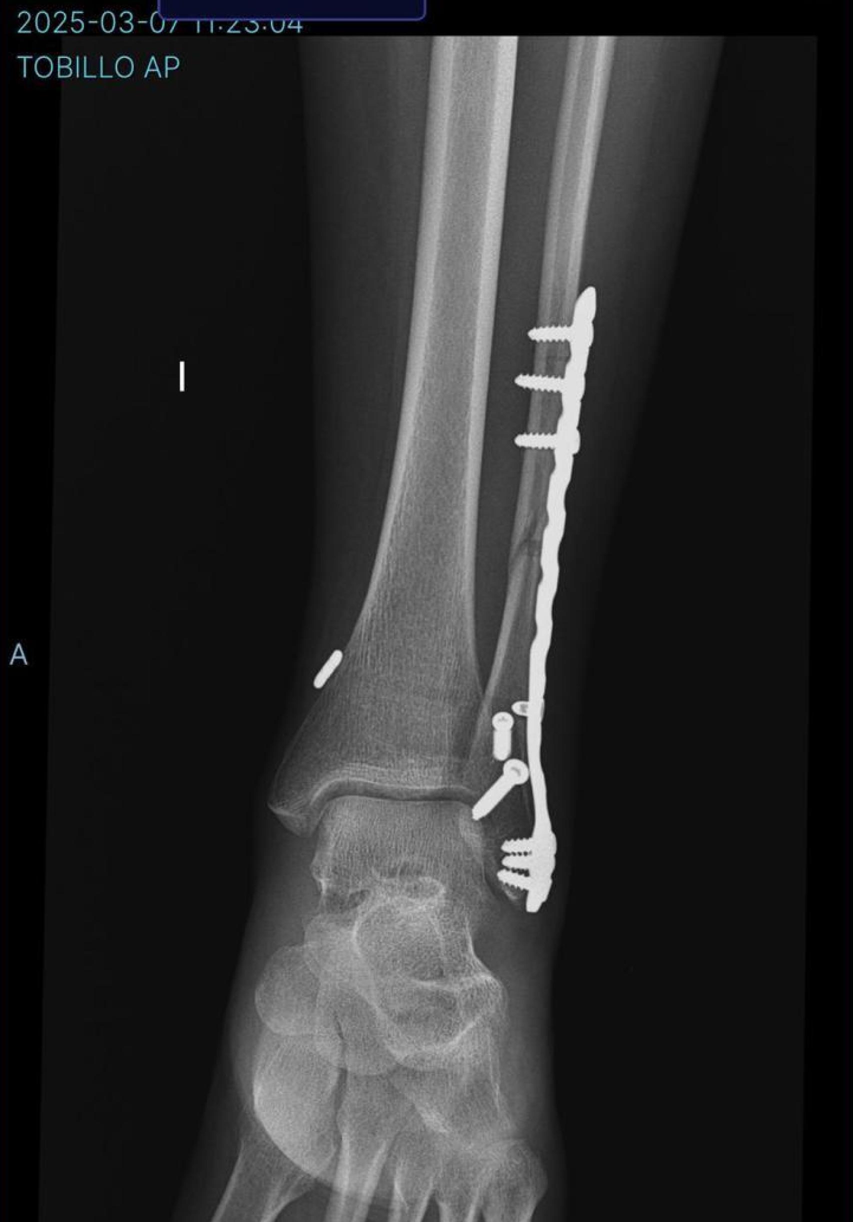 Radiografía tras la operación a la que se sometió Beatriz