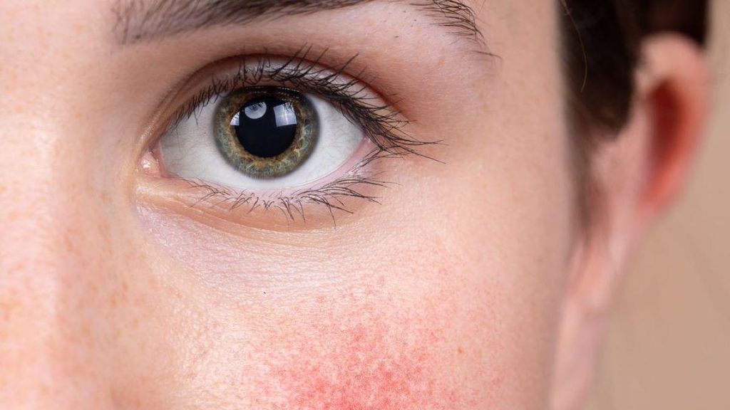 Mujer joven con la piel del rostro enrojecida y con pequeños granitos
