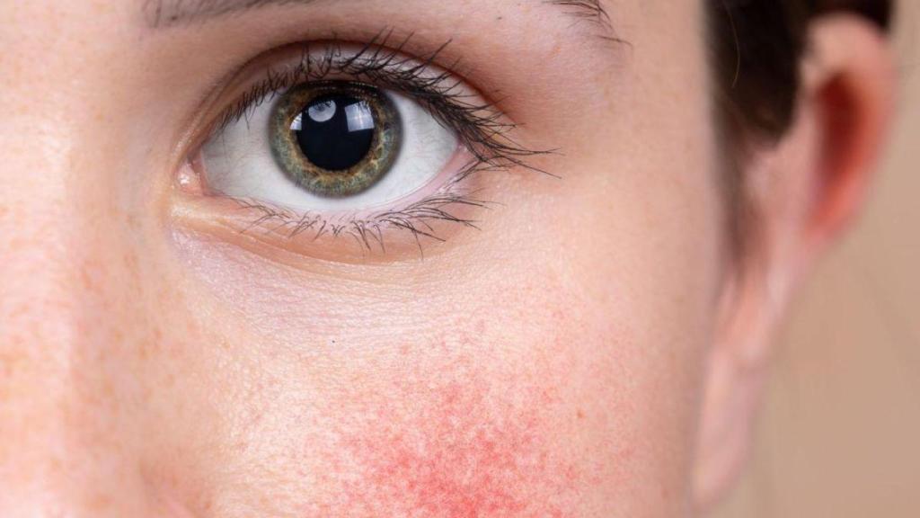 Mujer joven con la piel del rostro enrojecida y con pequeños granitos