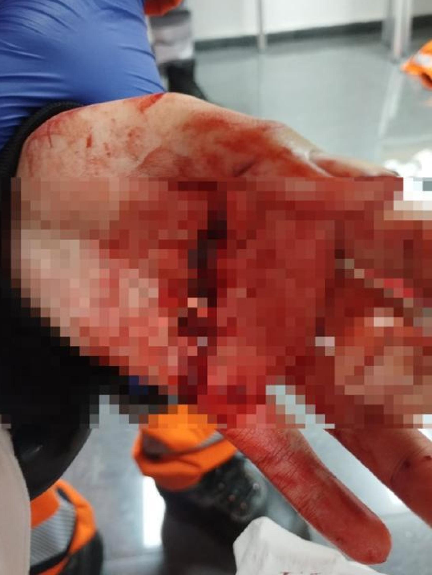 Grave corte en la mano tras la agresión con machetes