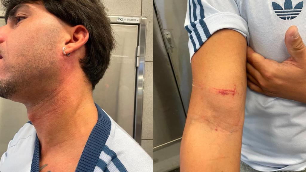 El joven agredido por dos ladrones en la L2 del metro de Barcelona