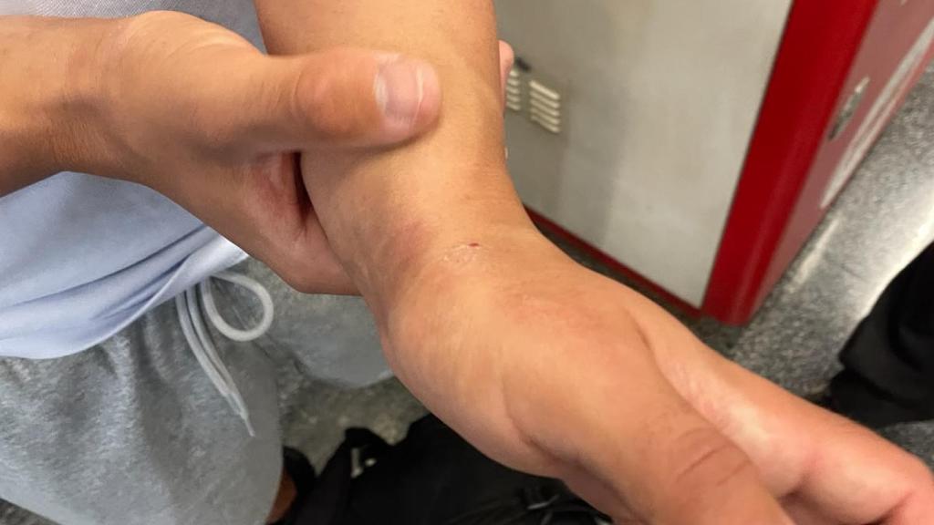 Imatge del canell malferit durant el robatori violent a la L2 del metro de Barcelona